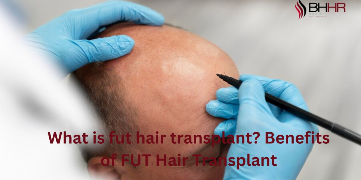 What is fut hair transplant? Benefits of FUT Hair Transplant